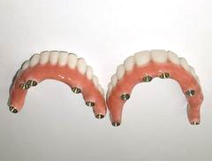 Полная имплантация зубов верхней и нижней челюсти