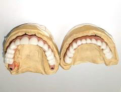 Имплантация зубов верхней и нижней челюсти все на 6-ти