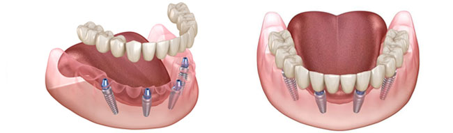 all-on-4 имплантация зубов