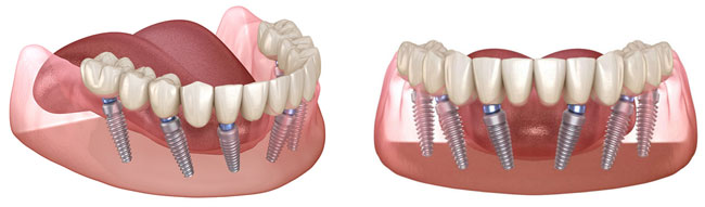 all-on-6 имплантация зубов
